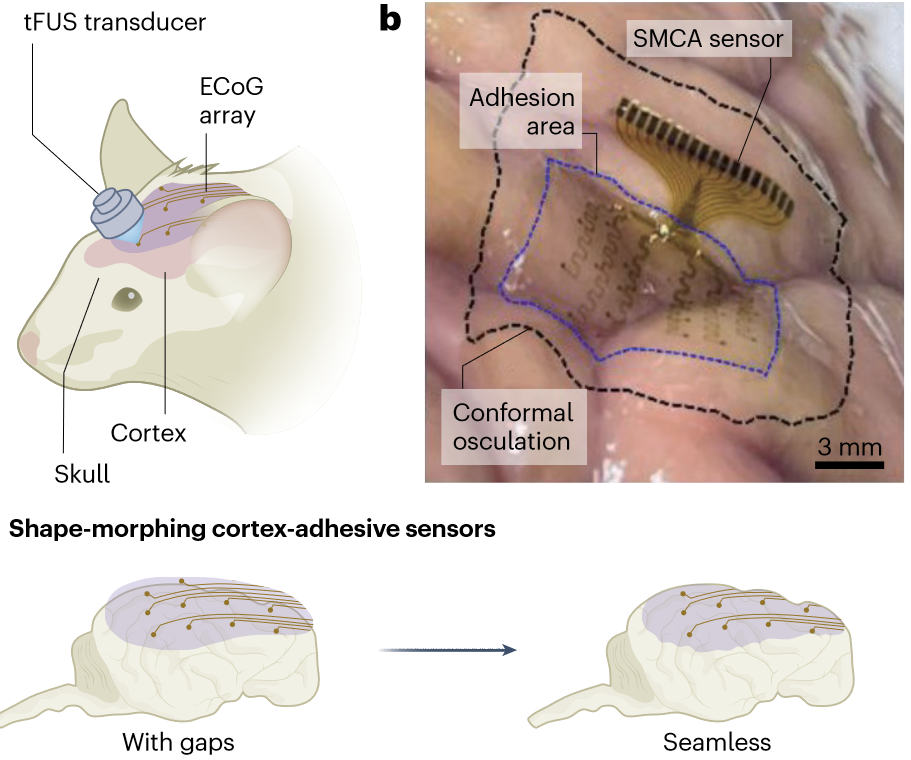A closed-loop neurostimulation device that reaches new levels (News & Views)