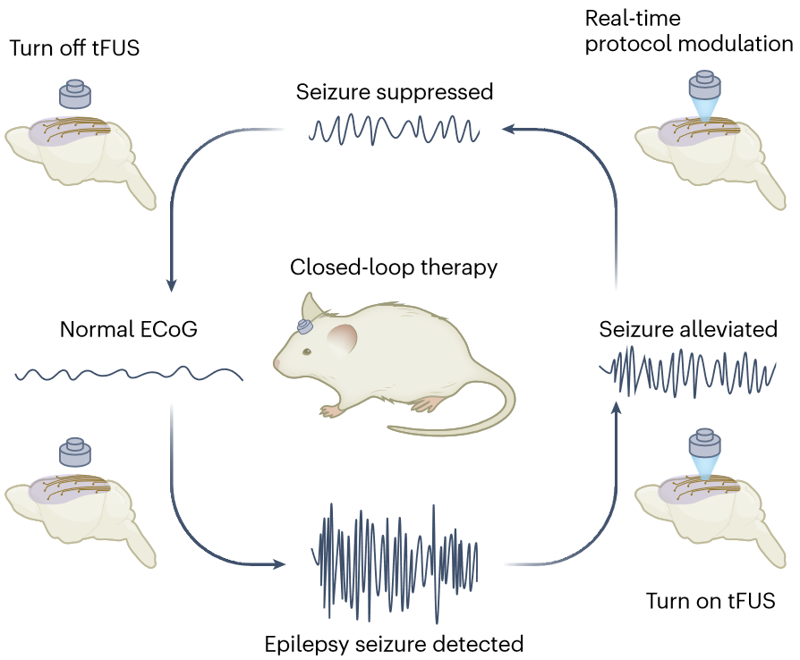 A closed-loop neurostimulation device that reaches new levels (News & Views)